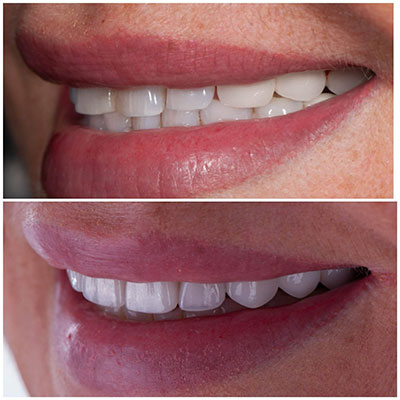 Smile transformation before and after treatment at Carrollwood Smiles, Tampa FL